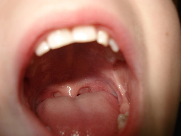 Tonsil stones and sea salt mouthwash